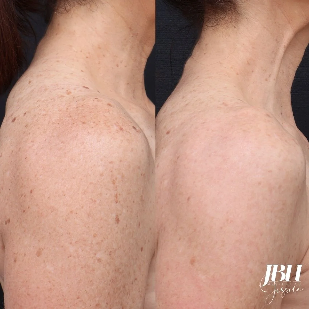 Before and After Pigmentation Removal Treatments - Results by JBH Aesthetics Camden
