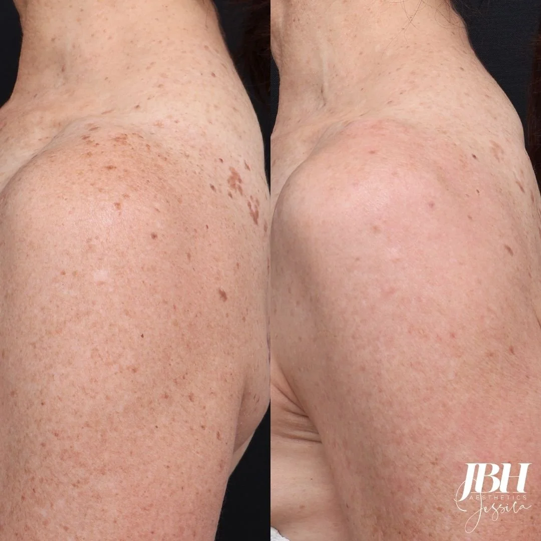 Before and After Pigmentation Removal Treatments - Results by JBH Aesthetics Camden