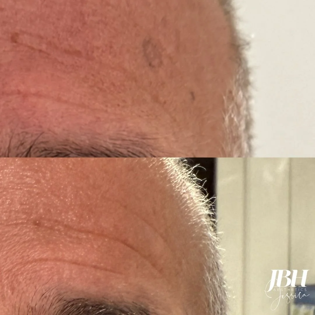 Before and After Pigmentation Removal Treatments - Results by JBH Aesthetics Camden