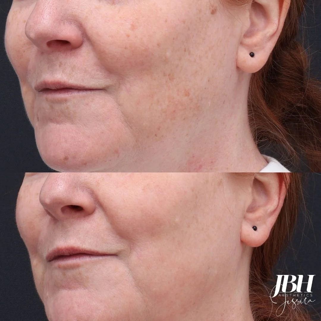 Before and After Pigmentation Removal Treatments - Results by JBH Aesthetics Camden