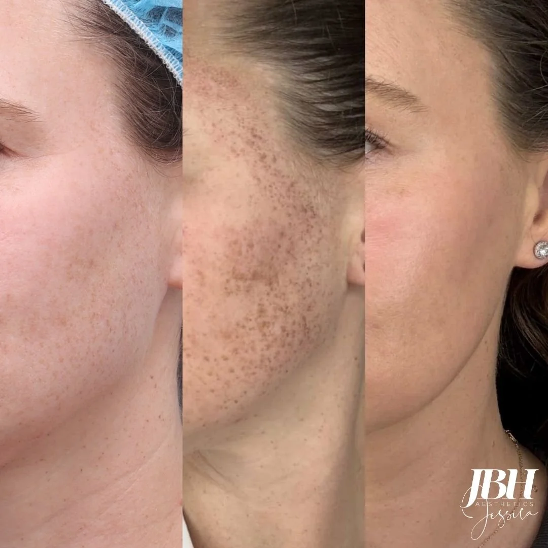 Before and After Pigmentation Removal Treatments - Results by JBH Aesthetics Camden