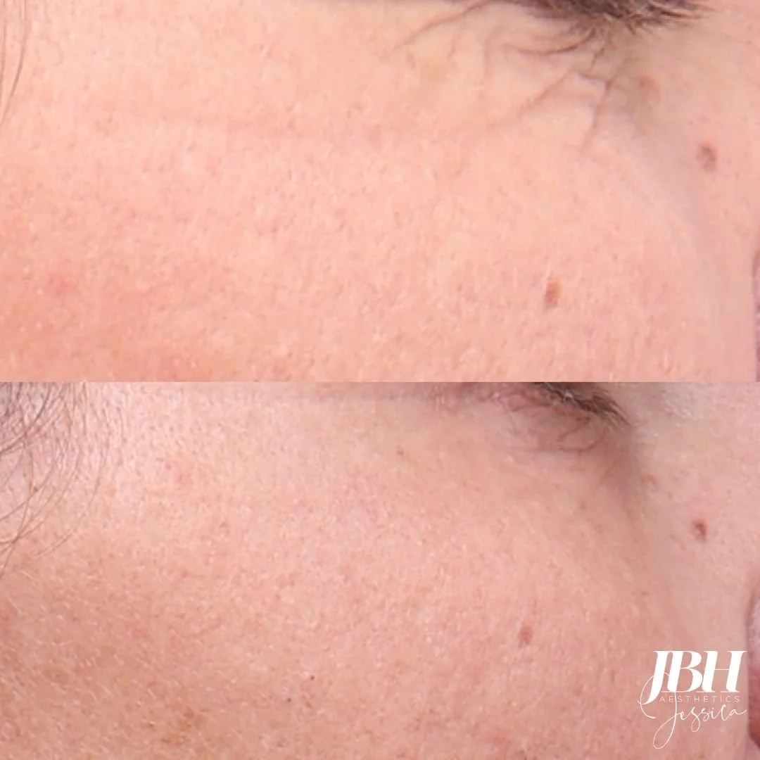 Before &amp; After Alma Hybrid Laser Treatments - Results by JBH Aesthetics Camden