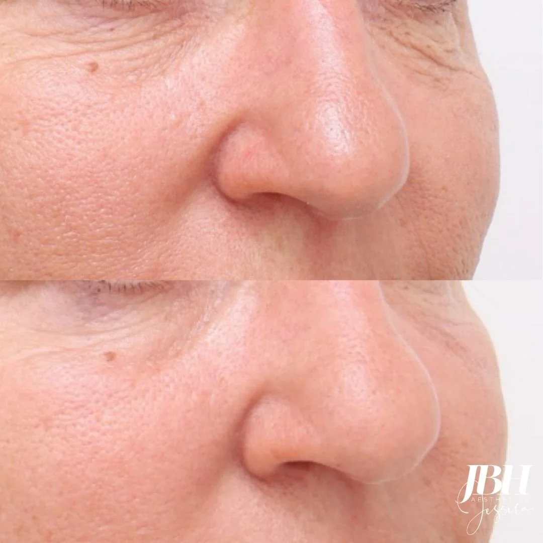 Before &amp; After Alma Hybrid Laser Treatments - Results by JBH Aesthetics Camden