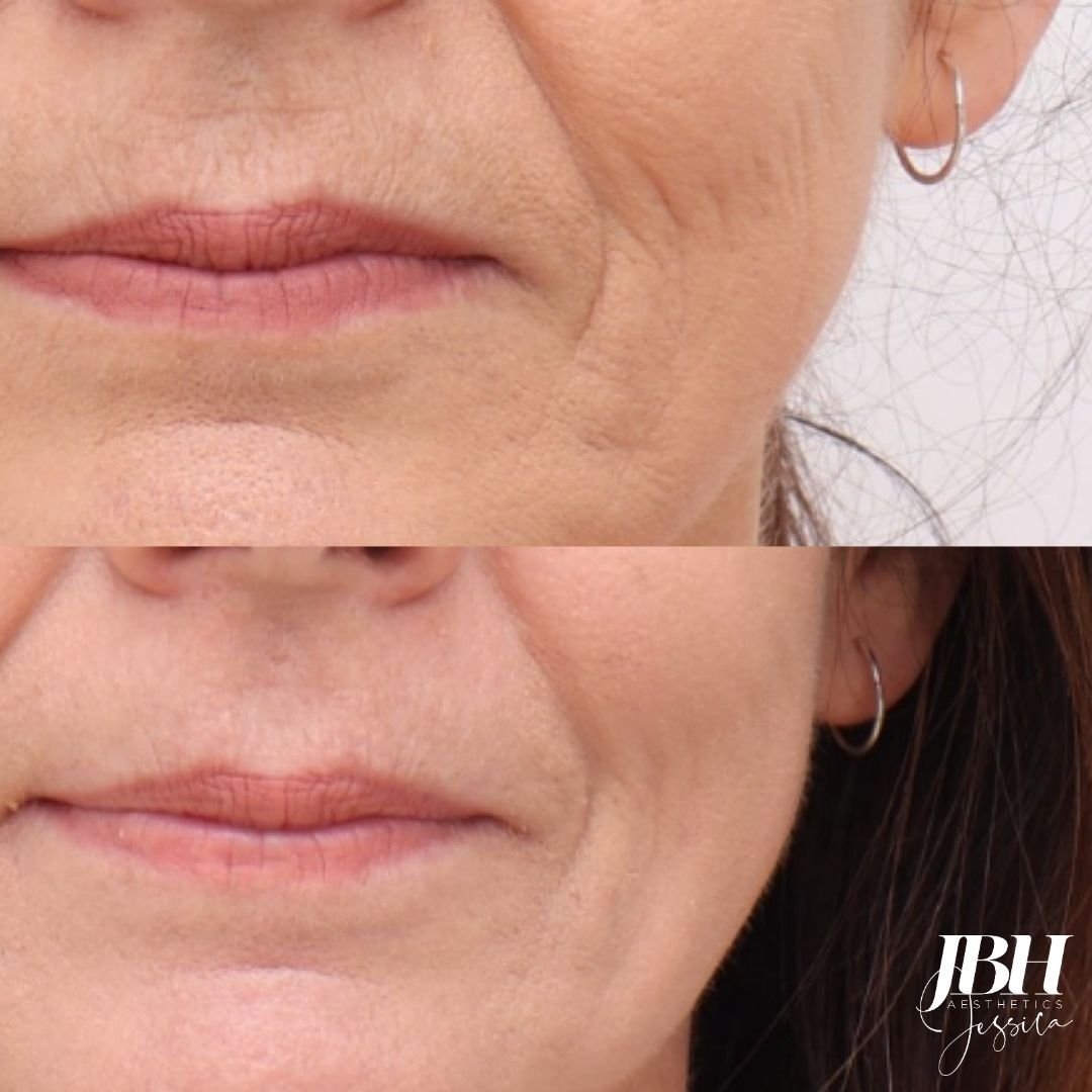 Before &amp; After Alma Hybrid Laser Treatments - Results by JBH Aesthetics Camden