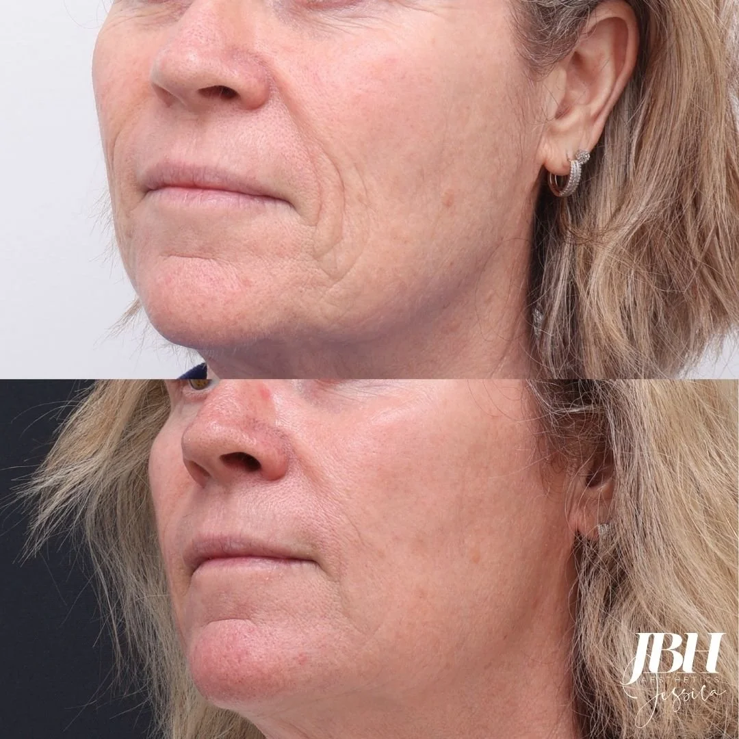 Before &amp; After Alma Hybrid Laser Treatments - Results by JBH Aesthetics Camden