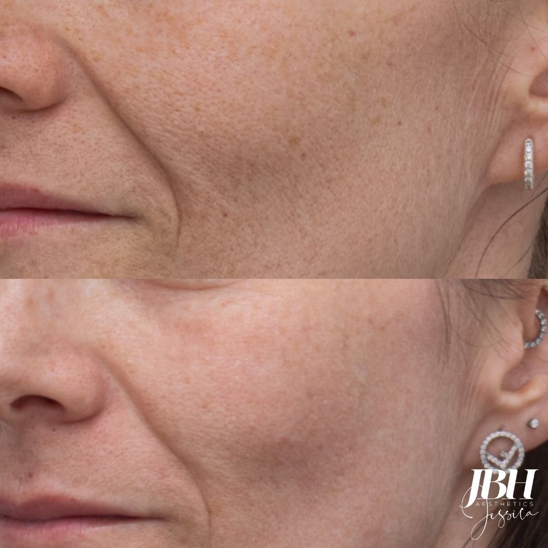 Before &amp; After Alma Hybrid Laser Treatments - Results by JBH Aesthetics Camden