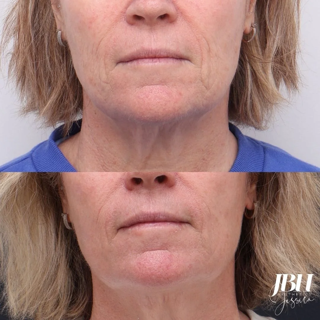 Before &amp; After Alma Hybrid Laser Treatments - Results by JBH Aesthetics Camden