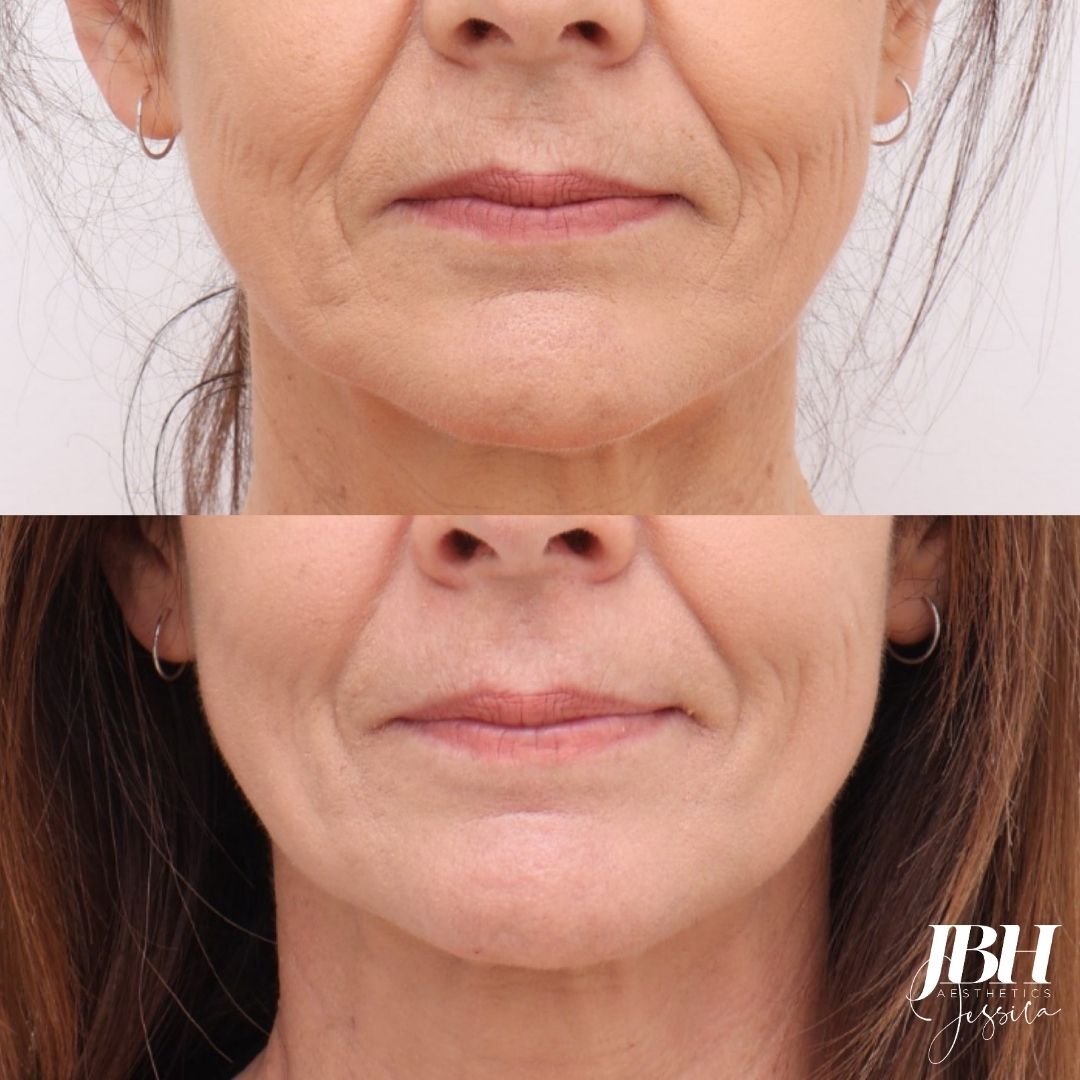 Before &amp; After Alma Hybrid Laser Treatments - Results by JBH Aesthetics Camden