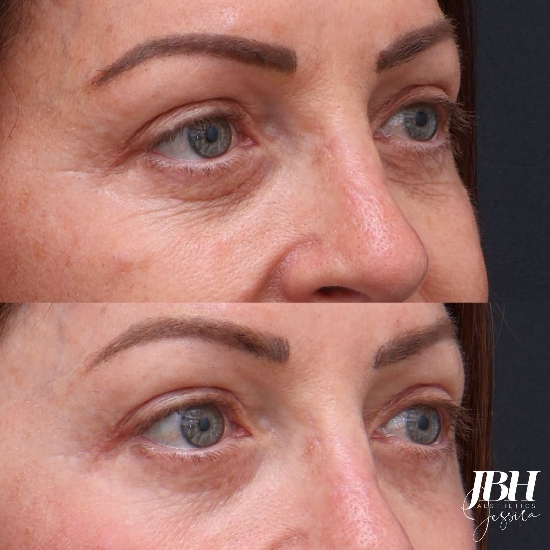 Before &amp; After Alma Hybrid Laser Treatments - Results by JBH Aesthetics Camden