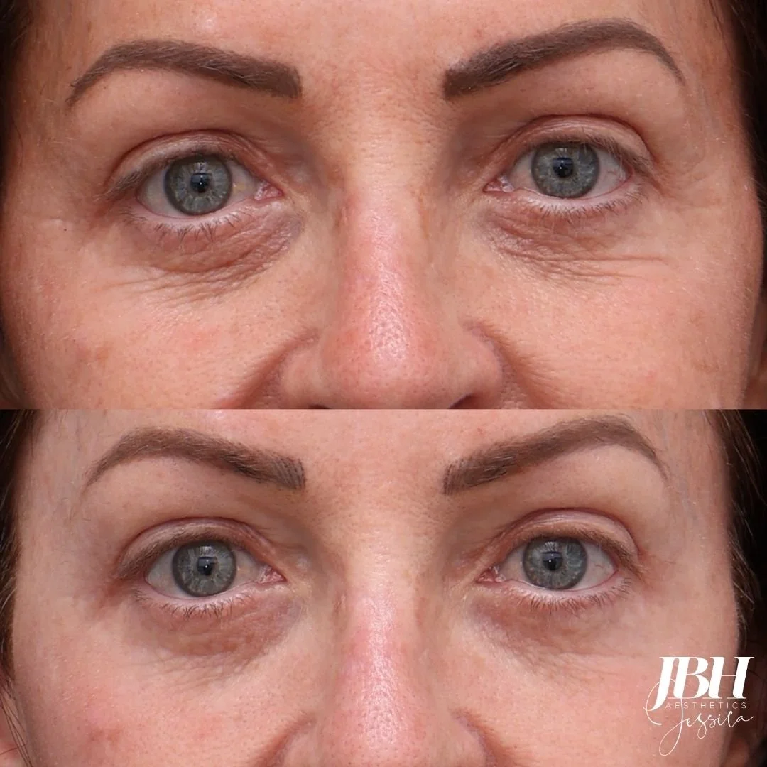 Before &amp; After Alma Hybrid Laser Treatments - Results by JBH Aesthetics Camden