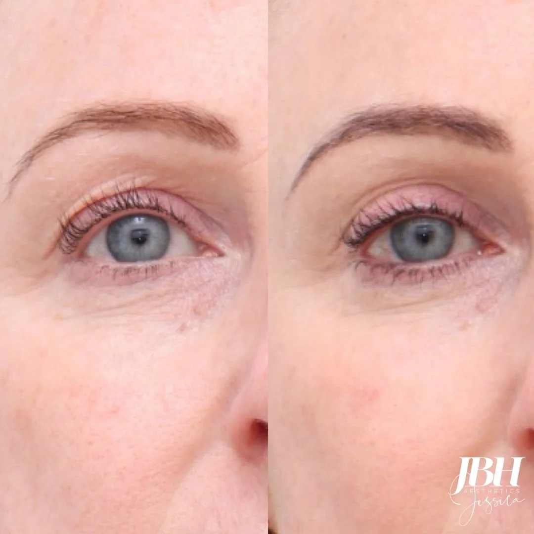 Before &amp; After Alma Hybrid Soft Lift Laser Treatments - Results by JBH Aesthetics Camden