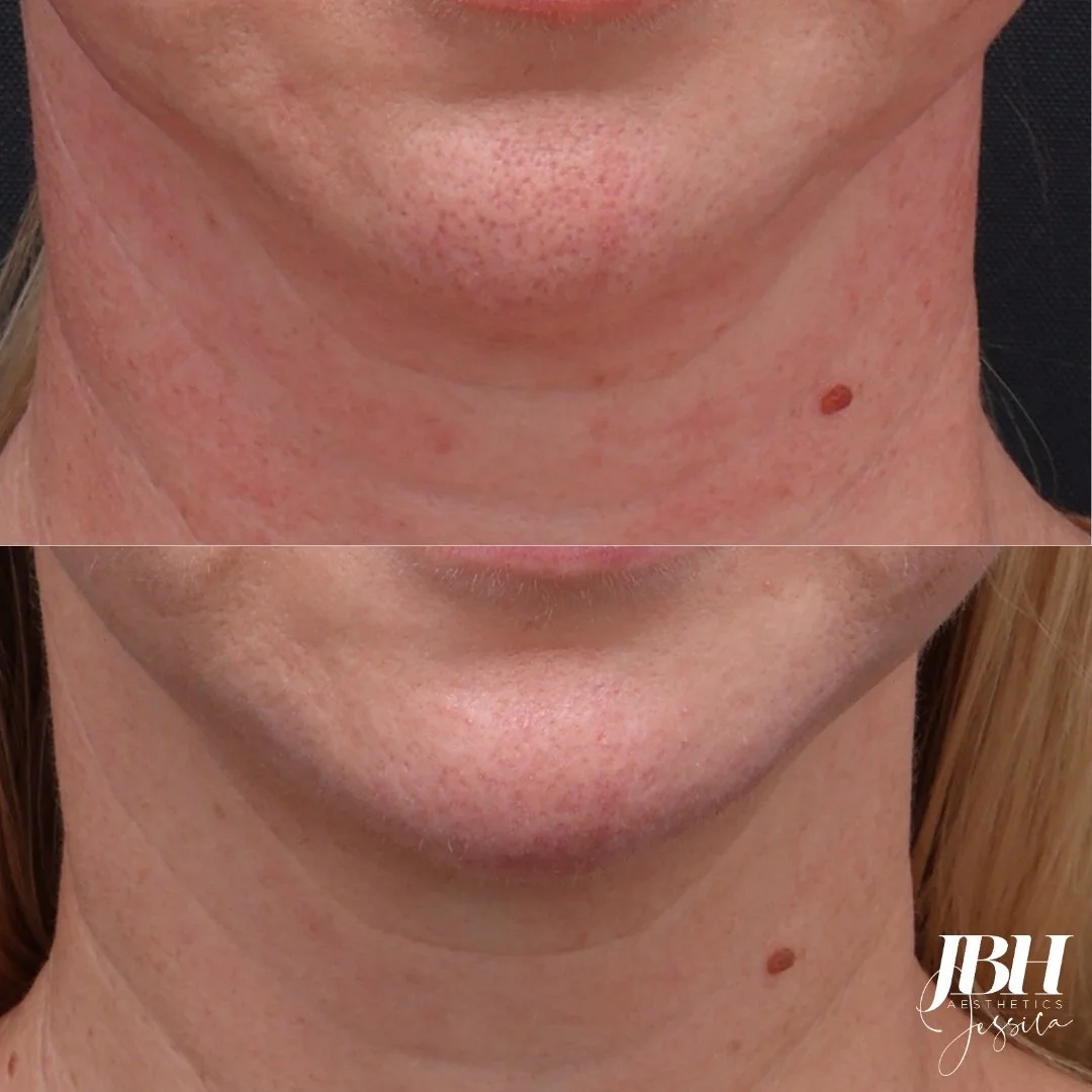 Redness Before and After - Results by JBH Aesthetics Camden (Copy)