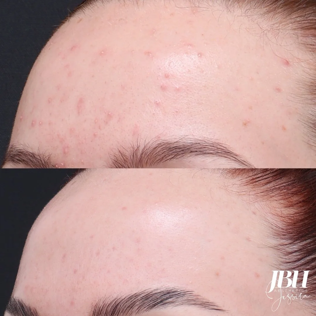 Before and After Acne Treatment - Results by JBH Aesthetics Camden