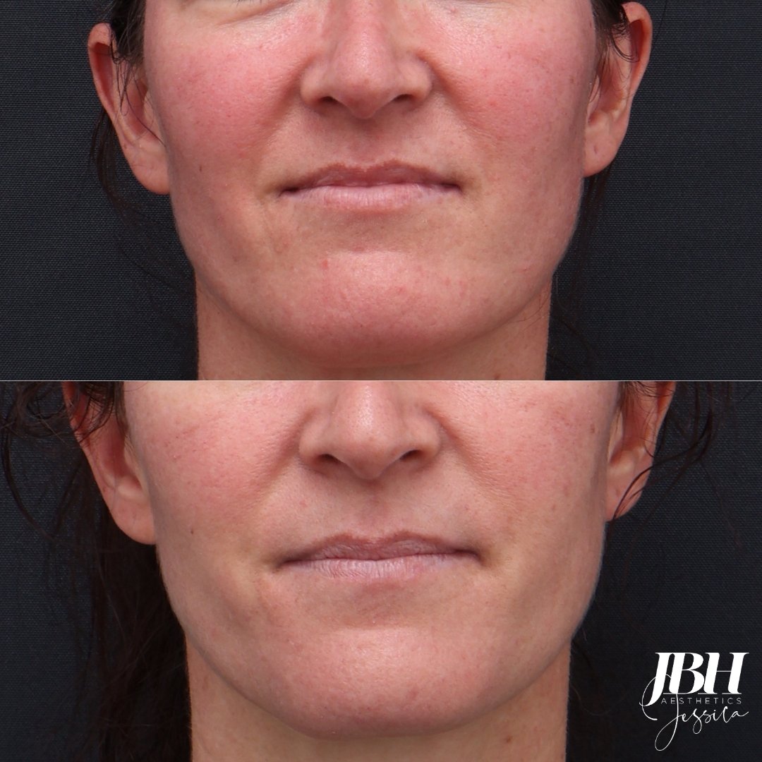 Redness Before and After - Results by JBH Aesthetics Camden (Copy)