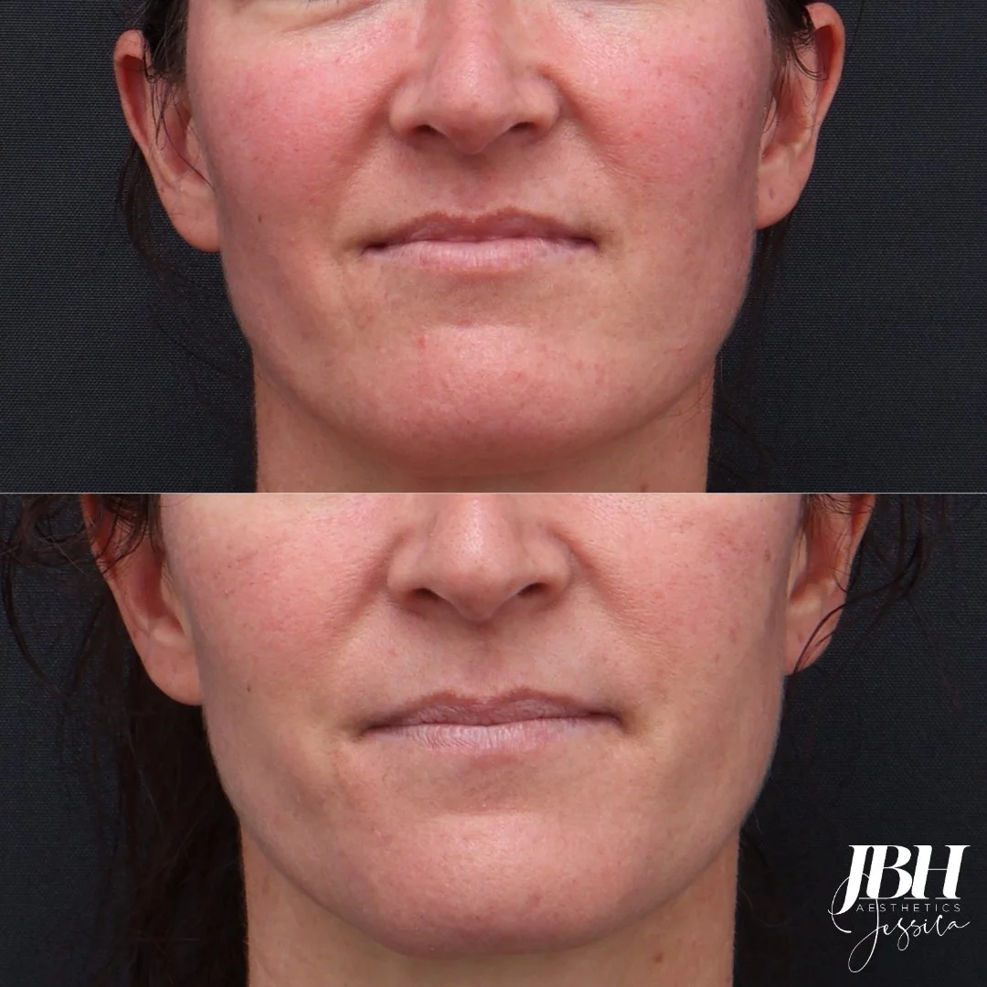 Before and After Laser Genesis Treatment - Results by JBH Aesthetics Camden