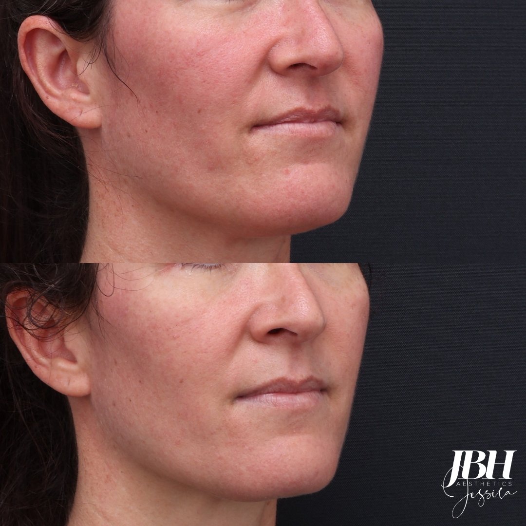 Before and After Laser Genesis Treatment - Results by JBH Aesthetics Camden