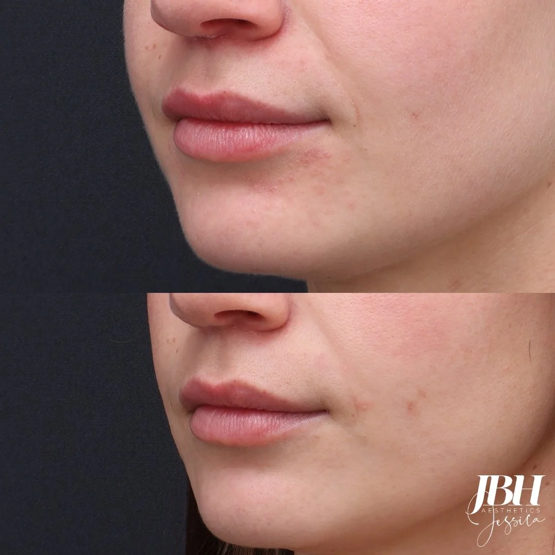 Before and After Laser Genesis Treatment - Results by JBH Aesthetics Camden