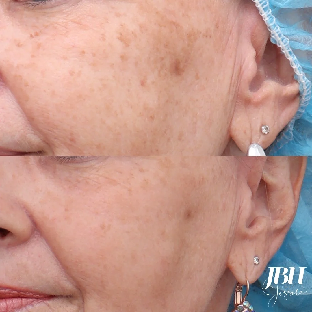 Before and After Pigmentation Removal Treatments - Results by JBH Aesthetics Camden