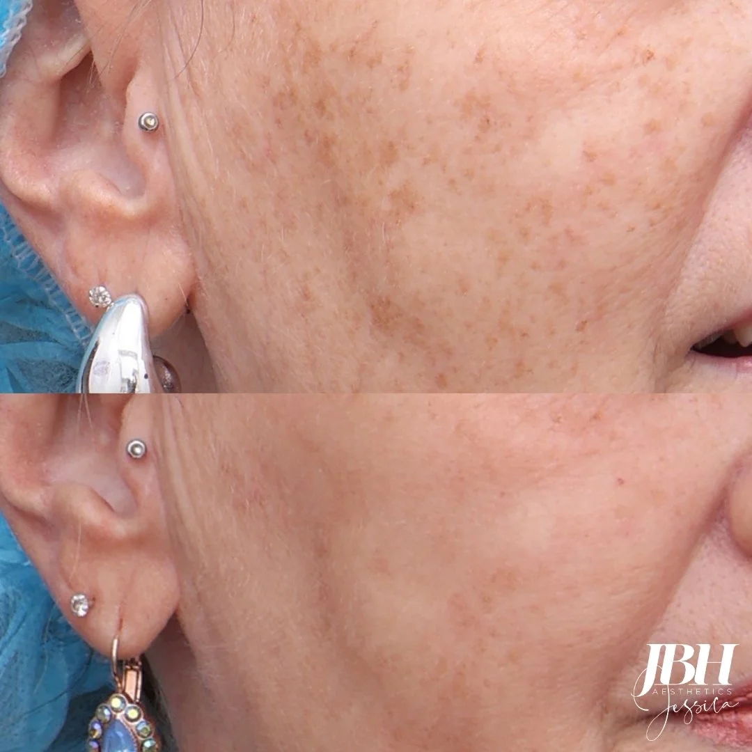 Before and After Pigmentation Removal Treatments - Results by JBH Aesthetics Camden