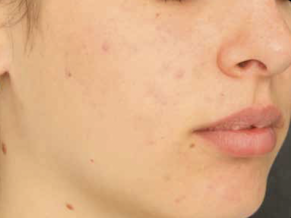 Alma Harmony ClearSkin After Photo - JBH Aesthetics Camden