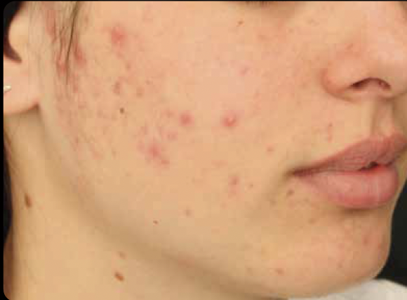 Alma Harmony ClearSkin Before Photo - JBH Aesthetics Camden