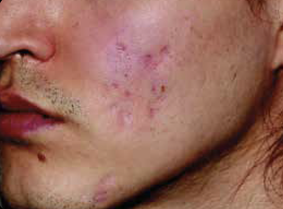 Alma Harmony ClearSkin Before Photo - JBH Aesthetics Camden