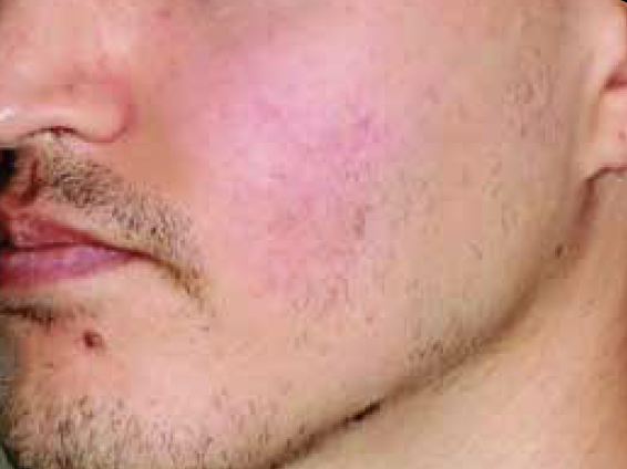 Alma Harmony ClearSkin After Photo - JBH Aesthetics Camden