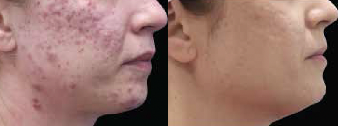 Alma Harmony Iris Acne Before and After Results Photos - JBH Aesthetics Camden