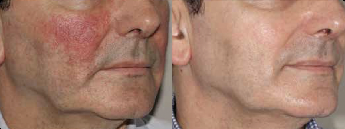 Alma Harmony Iris Acne Before and After Results Photos - JBH Aesthetics Camden
