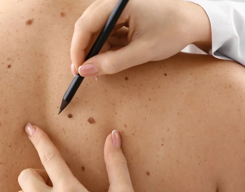 Skin Cancer Checks and Biopsies Camden NSW | JBH Aesthetics