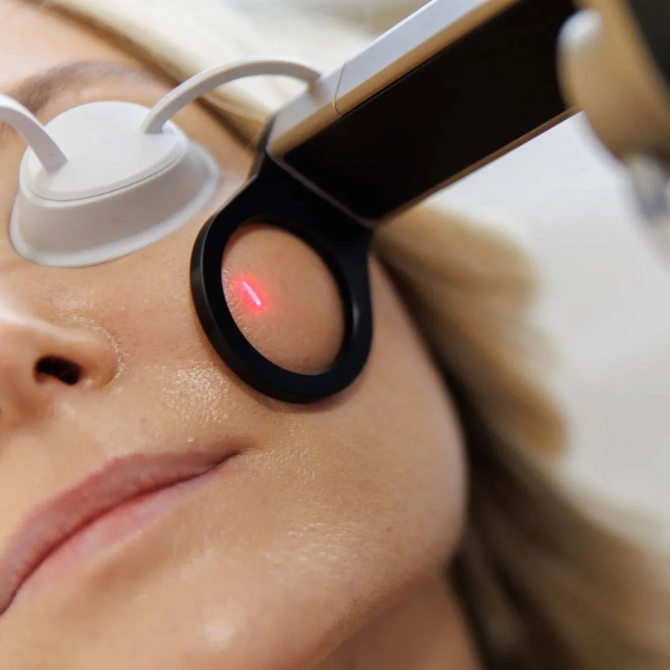 Alma Hybrid Laser Treatments at JBH Aesthetics in Camden