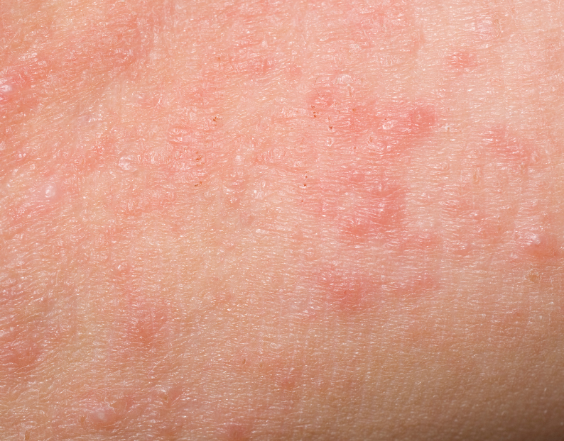 Sensitive Skin Treatments at JBH Aesthetics Camden NSW