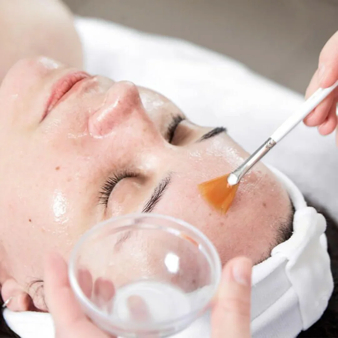 Corrective Skin Peels at JBH Aesthetics Camden