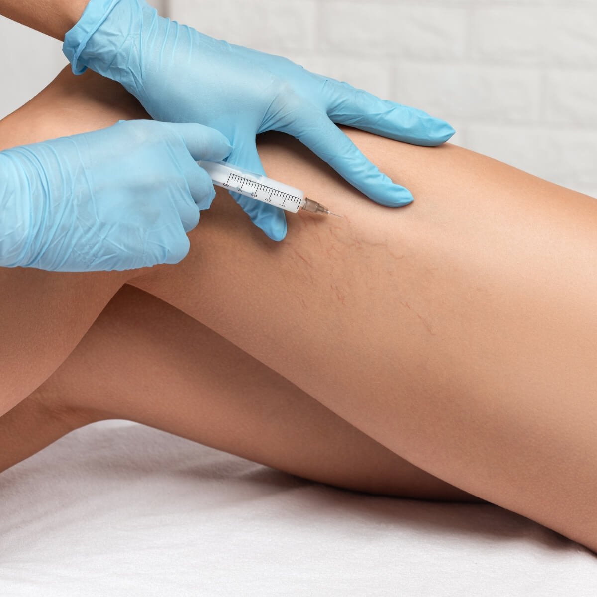 Sclerotherapy for Reticular & Spider Veins