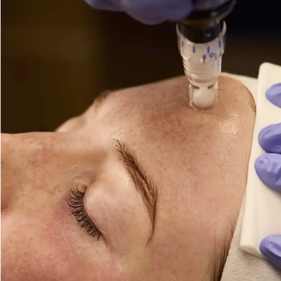 Advanced Microneedling Camden - JBH Aesthetics Macarthur