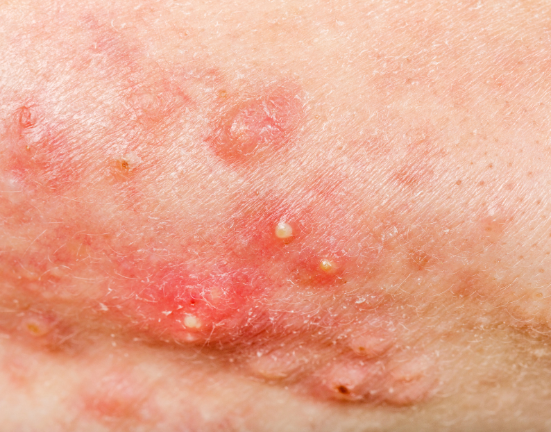 Acne Treatments at JBH Aesthetics Camden NSW