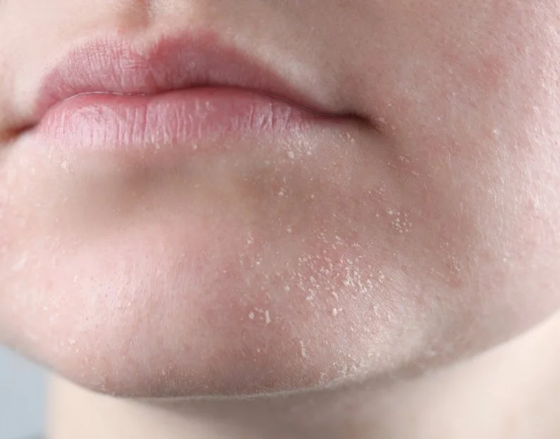 Dry & Dehydrated Skin Treatments - JBH Aesthetics Camden