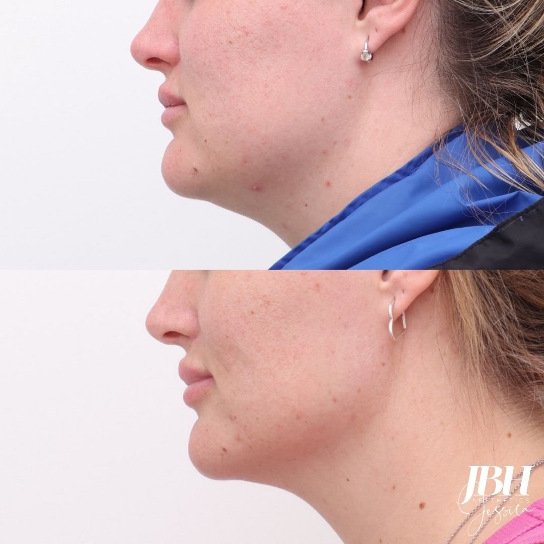 Morpheus8 Before and After Treatments - Results by JBH Aesthetics Camden