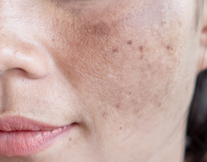 Pigmentation and Melasma Skin Treatments at JBH Aesthetics Camden NSW