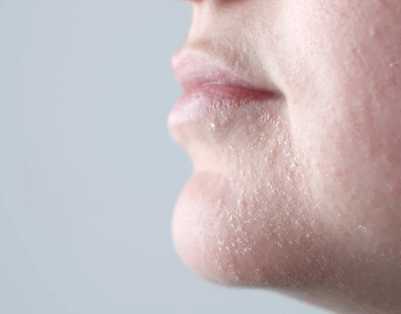 Dry & Dehydrated Skin Treatments at JBH Aesthetics Camden