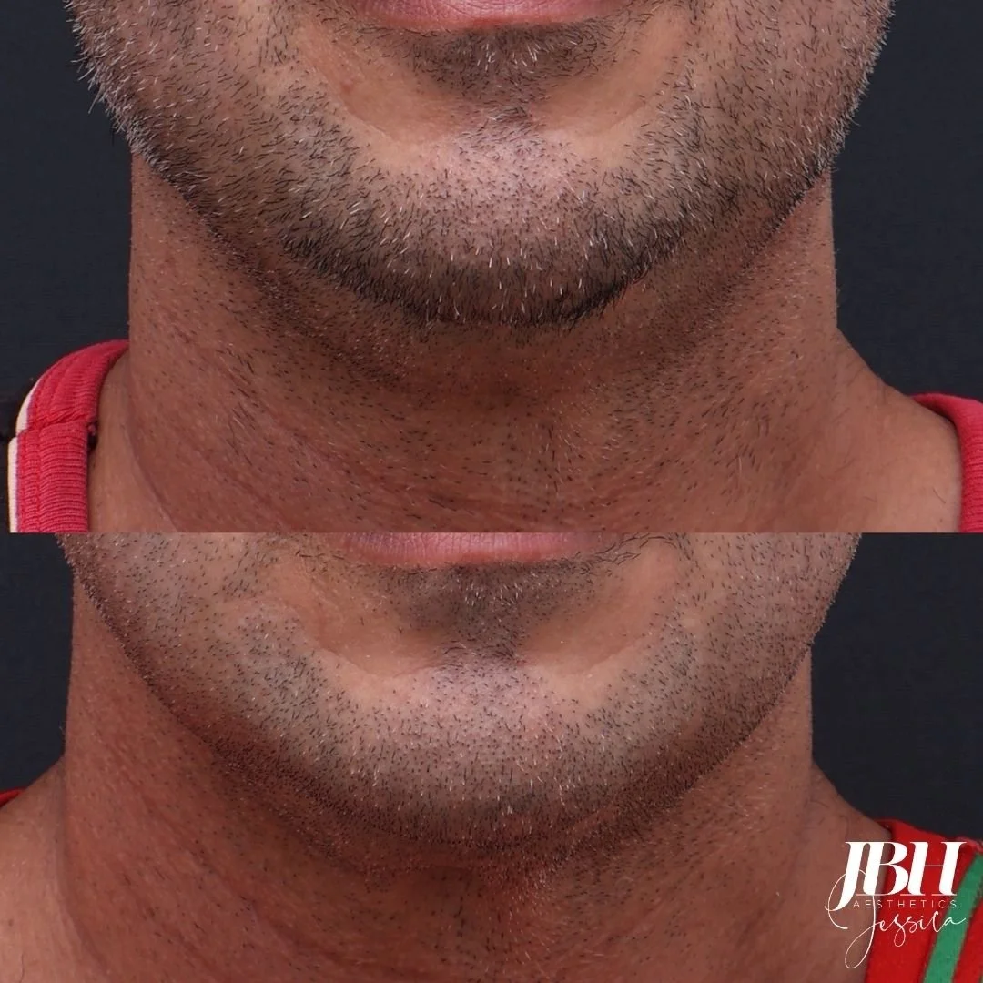 Morpheus8 Before and After Treatments - Results by JBH Aesthetics Camden