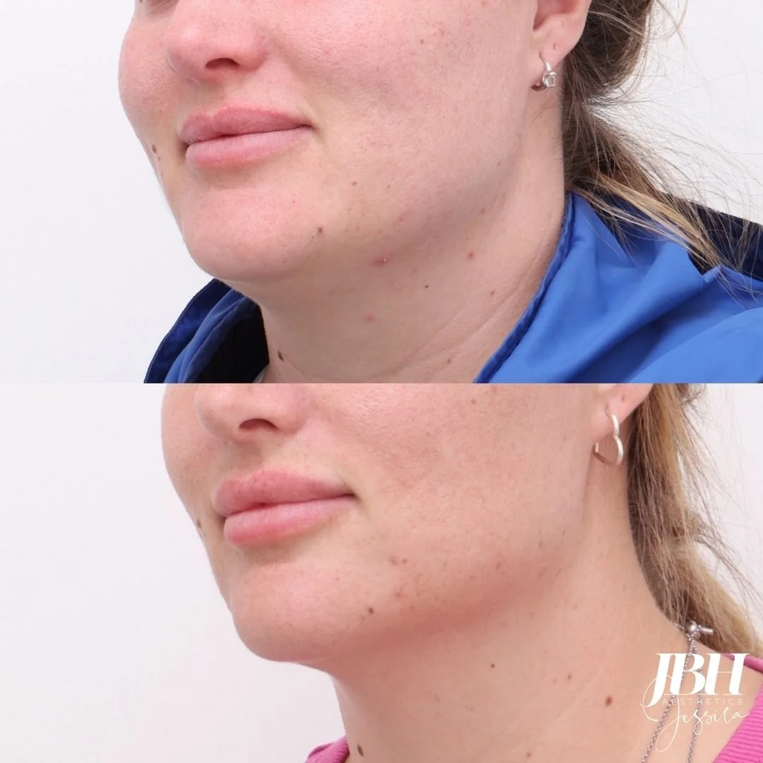 Morpheus8 Before and After Treatments - Results by JBH Aesthetics Camden