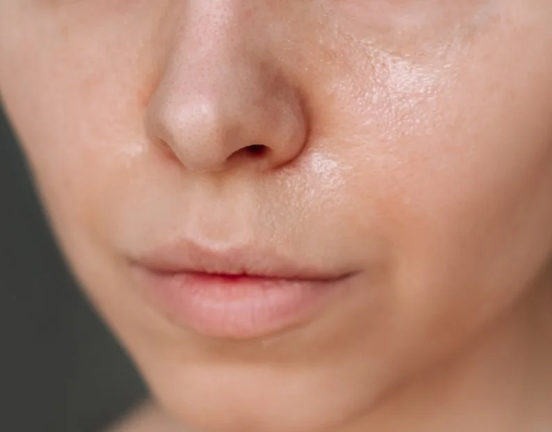 Oily & Congested Skin Treatments - JBH Aesthetics Camden
