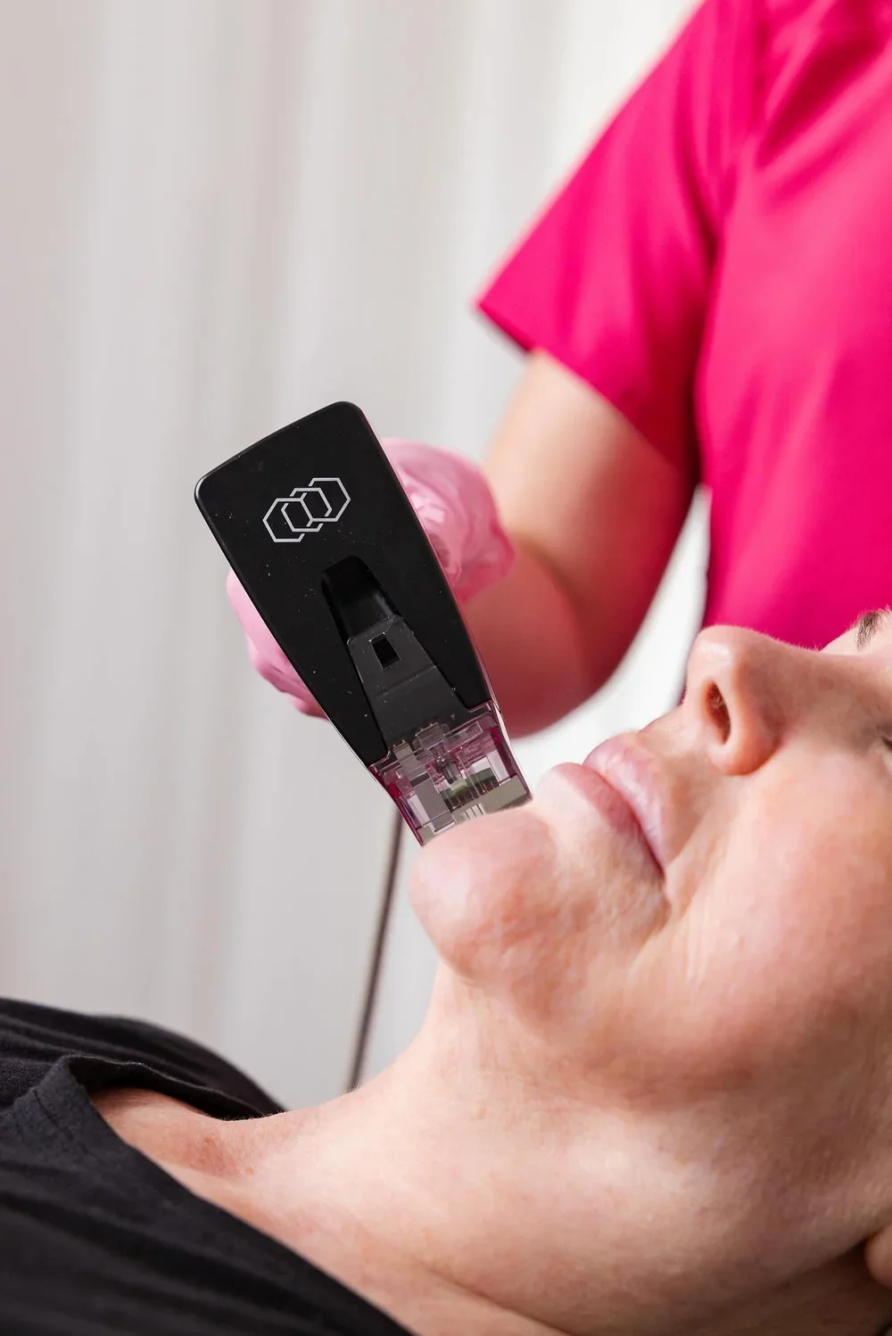 Morpheus8 RF Microneedling at JBH Aesthetics Camden