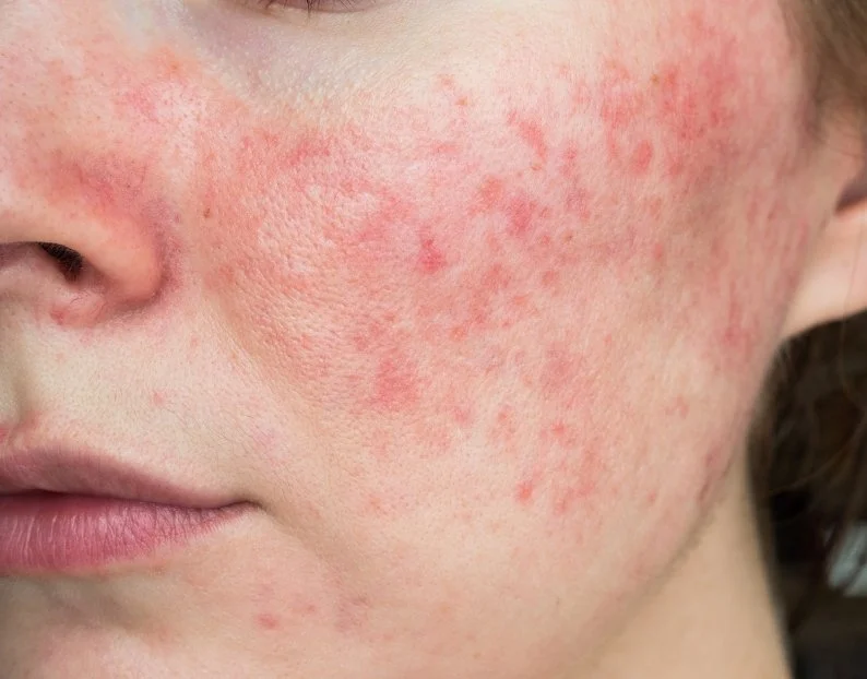 Rosacea