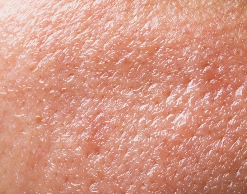 Oily and Congested Skin Treatments - JBH Aesthetics Camden NSW