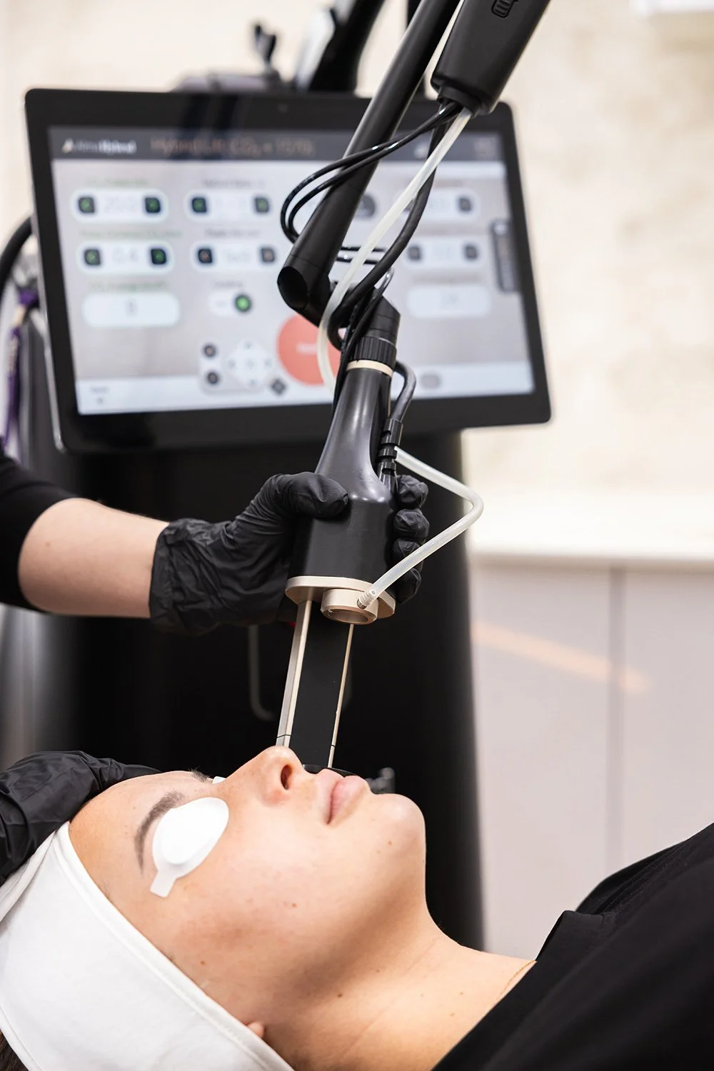 Alma Hybrid Laser Treatments at JBH Aesthetics in Camden