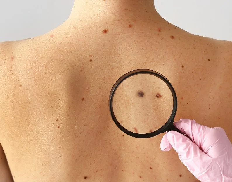 Skin Cancer Checks and Biopsies Camden NSW | JBH Aesthetics