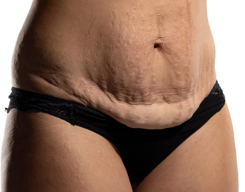 Loose Skin Tightening Treatments - JBH Aesthetics Camden NSW