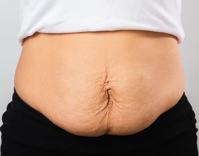 Muscle Separation Post Pregnancy Treatments - JBH Aesthetics Camden NSW